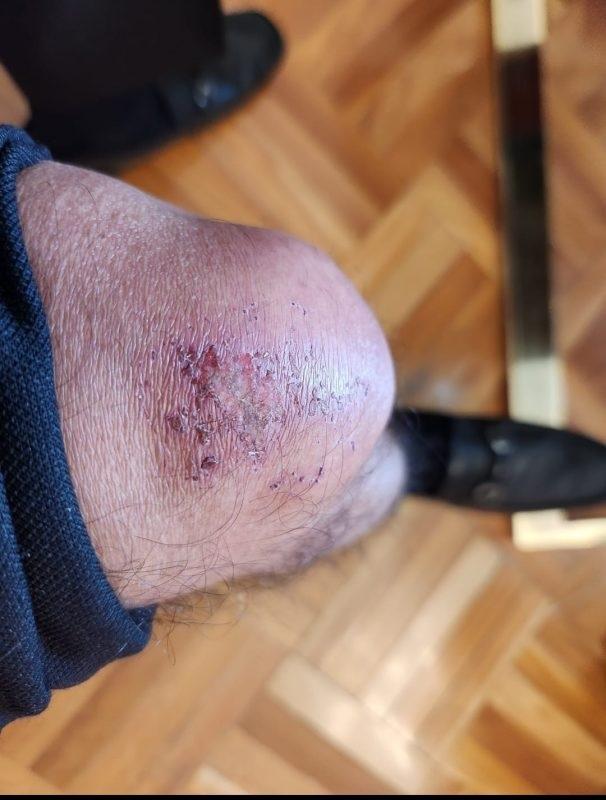 rodilla de petro